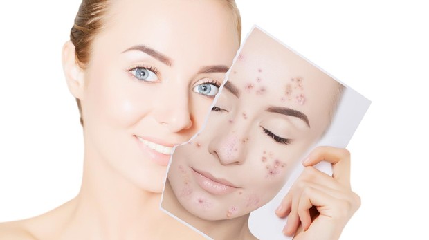 Acne treatment facial – Life Spa